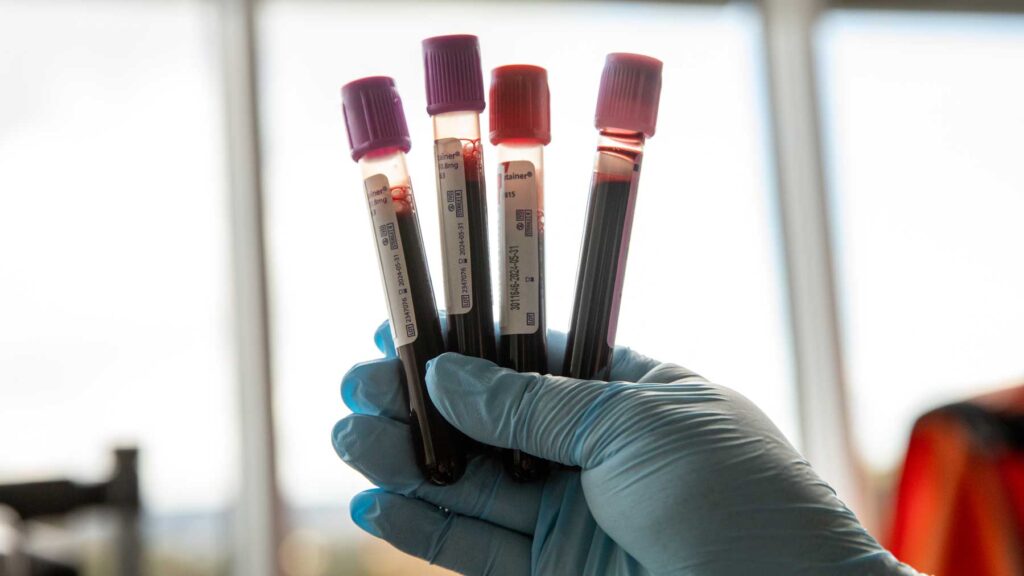 breakthrough-in-early-detection-of-type-2-diabetes-through-microrna