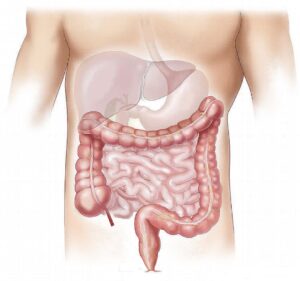 global-surge-in-early-onset-gastrointestinal-cancers-colorectal-cancer-leads-the-charge
