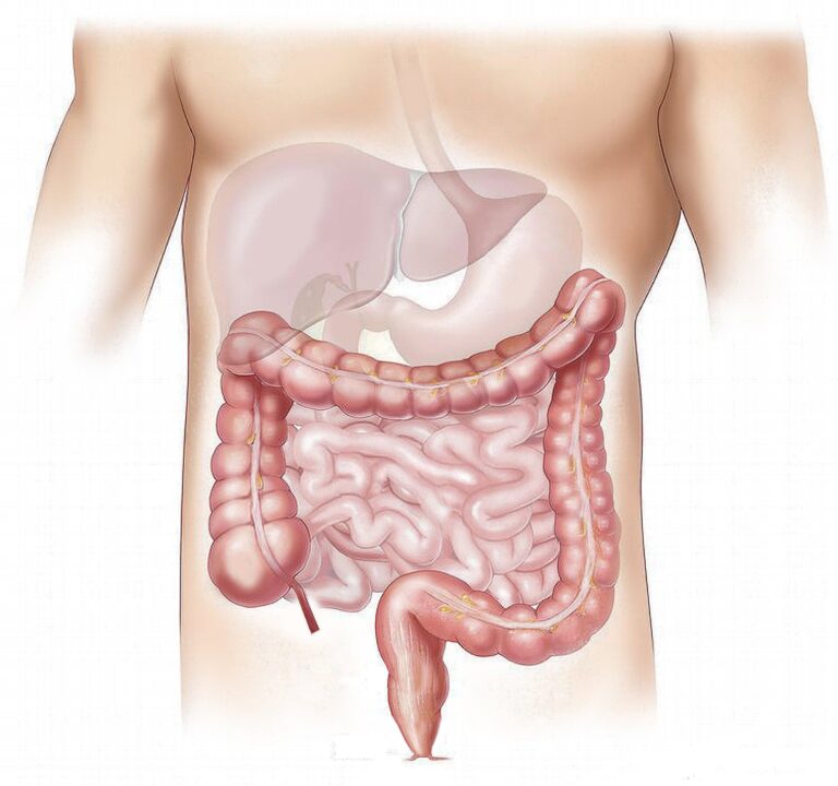 global-surge-in-early-onset-gastrointestinal-cancers-colorectal-cancer-leads-the-charge