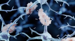 new-study-reveals-over-200-misfolded-proteins-linked-to-alzheimer-s-and-dementia