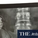 study-questions-efficacy-of-costly-spinal-cord-stimulators