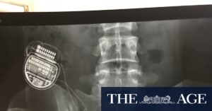 study-questions-efficacy-of-costly-spinal-cord-stimulators