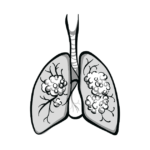 targeted-radiation-shows-promise-for-sclc-brain-metastases