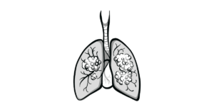 targeted-radiation-shows-promise-for-sclc-brain-metastases