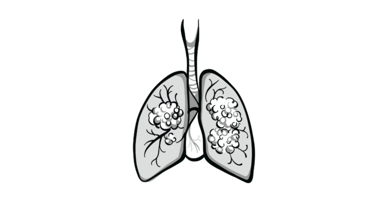 targeted-radiation-shows-promise-for-sclc-brain-metastases