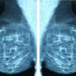 ai-revolutionizes-mental-health-care-for-breast-cancer-patients