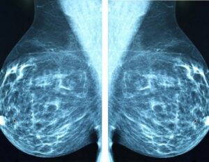 ai-revolutionizes-mental-health-care-for-breast-cancer-patients