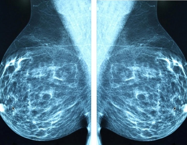 ai-revolutionizes-mental-health-care-for-breast-cancer-patients
