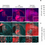 axonal-injury-a-targetable-driver-in-glioblastoma-progression