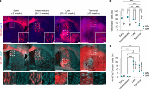axonal-injury-a-targetable-driver-in-glioblastoma-progression