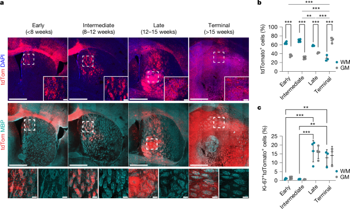 axonal-injury-a-targetable-driver-in-glioblastoma-progression