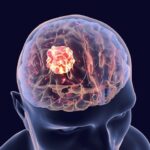 innovative-approach-may-slow-aggressive-glioblastoma-growth