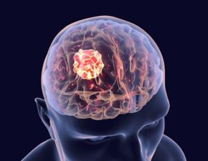 innovative-approach-may-slow-aggressive-glioblastoma-growth