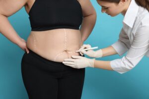 long-term-vitamin-deficiencies-plague-bariatric-surgery-patients