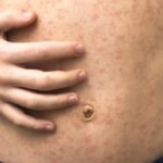 Sick child with red rash spots from measles.