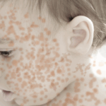 measles-resurgence-in-2025-a-call-for-renewed-vigilance-and-vaccination