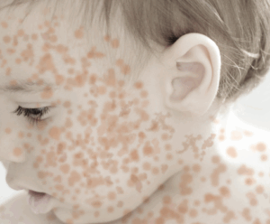 measles-resurgence-in-2025-a-call-for-renewed-vigilance-and-vaccination