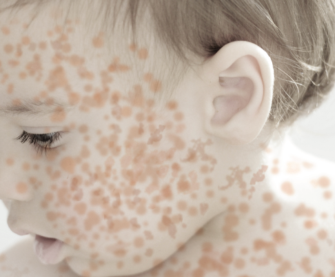 measles-resurgence-in-2025-a-call-for-renewed-vigilance-and-vaccination