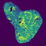 mitochondrial-metabolite-glutathione-linked-to-breast-cancer-metastasis