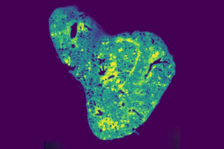 mitochondrial-metabolite-glutathione-linked-to-breast-cancer-metastasis