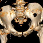 new-study-links-neutrophils-and-dkk1-to-immune-suppression-in-bone-cancer