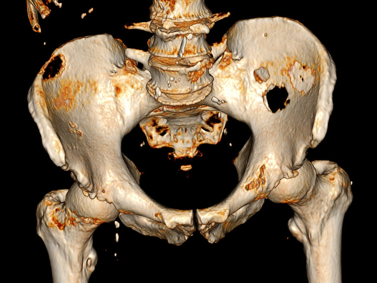 new-study-links-neutrophils-and-dkk1-to-immune-suppression-in-bone-cancer