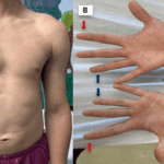 understanding-isolated-hemihyperplasia-in-adolescents-a-medical-insight