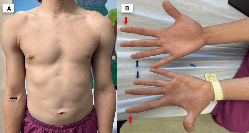 understanding-isolated-hemihyperplasia-in-adolescents-a-medical-insight