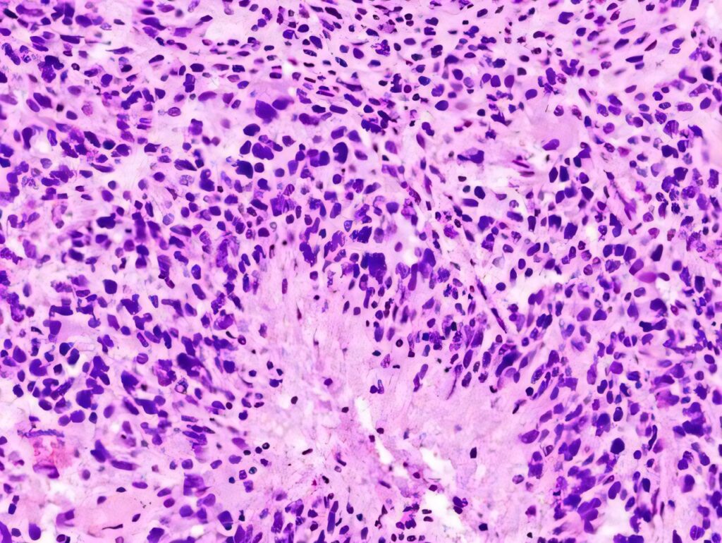 new-study-unveils-how-glioblastoma-cells-become-more-aggressive