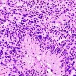new-study-unveils-how-glioblastoma-cells-become-more-aggressive