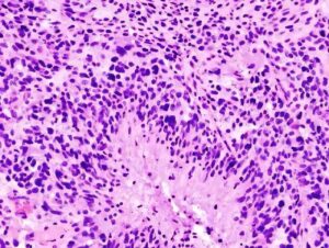new-study-unveils-how-glioblastoma-cells-become-more-aggressive