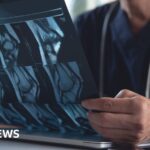 ai-breakthrough-in-predicting-osteoarthritis-progression-unveiled-by-surrey-researchers