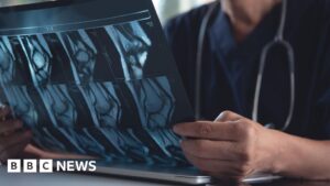 ai-breakthrough-in-predicting-osteoarthritis-progression-unveiled-by-surrey-researchers
