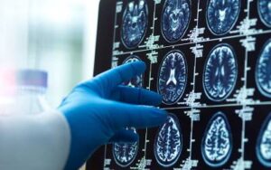 breakthrough-mri-scans-could-revolutionize-dementia-diagnosis