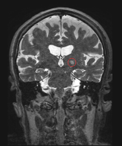 breakthroughs-in-focused-ultrasound-offer-new-hope-for-cancer-and-alzheimer-s-treatment