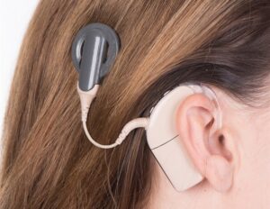 cochlear-implants-sound-quality-s-impact-on-quality-of-life
