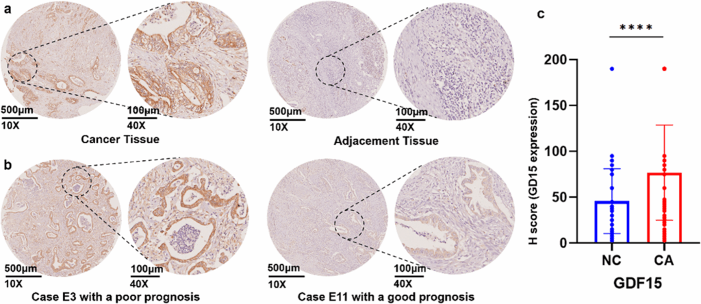 gdf15-a-new-hope-for-predicting-survival-in-pancreatic-cancer