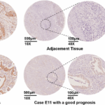 gdf15-a-new-hope-for-predicting-survival-in-pancreatic-cancer