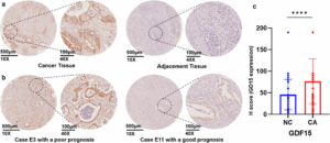 gdf15-a-new-hope-for-predicting-survival-in-pancreatic-cancer