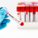 Blood,Sample,Positive,With,Measles,Virus