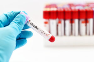 Blood,Sample,Positive,With,Measles,Virus