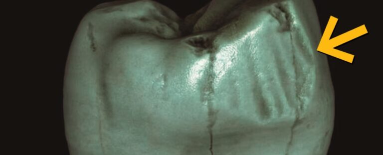 neanderthal-toothpick-grooves-rethought-new-study-challenges-old-assumptions
