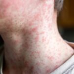 Measles viral disease, human skin covered with measles rash, vaccination concept