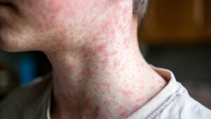 Measles viral disease, human skin covered with measles rash, vaccination concept