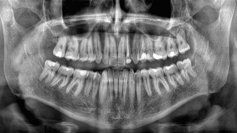 rapid-tooth-loss-in-seniors-linked-to-increased-mortality-risk