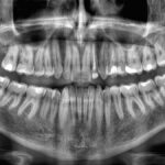 rapid-tooth-loss-linked-to-increased-mortality-risk-study-reveals