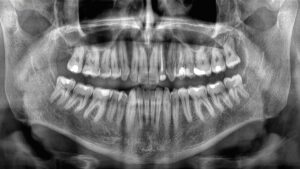rapid-tooth-loss-linked-to-increased-mortality-risk-study-reveals