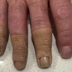 australian-prosthetics-clients-seek-compensation-amid-investigation