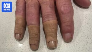 australian-prosthetics-clients-seek-compensation-amid-investigation