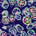 measles-alert-in-sydney-unknown-source-sparks-health-concerns